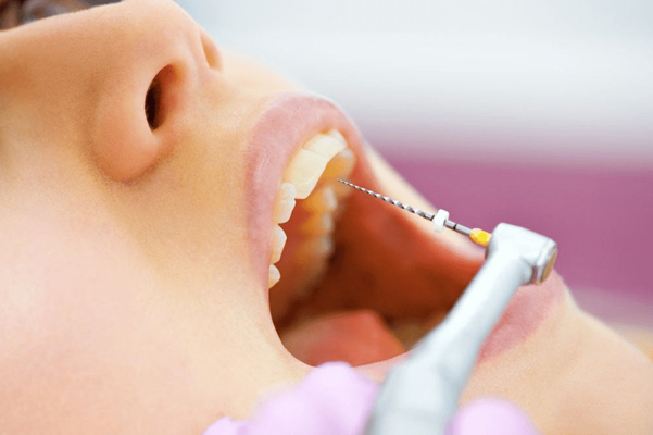 Root Canal Treatment Procedure, Hamilton, ON | Charlton Dentistry Root canal treatment procedure being performed at Charlton Dentistry in Hamilton, ON