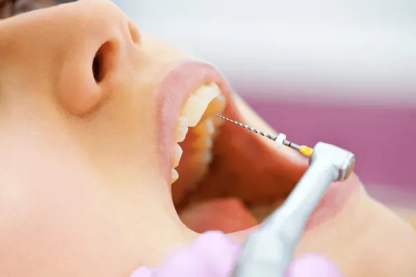 Root canal treatment procedure being performed at Charlton Dentistry in Hamilton, ON