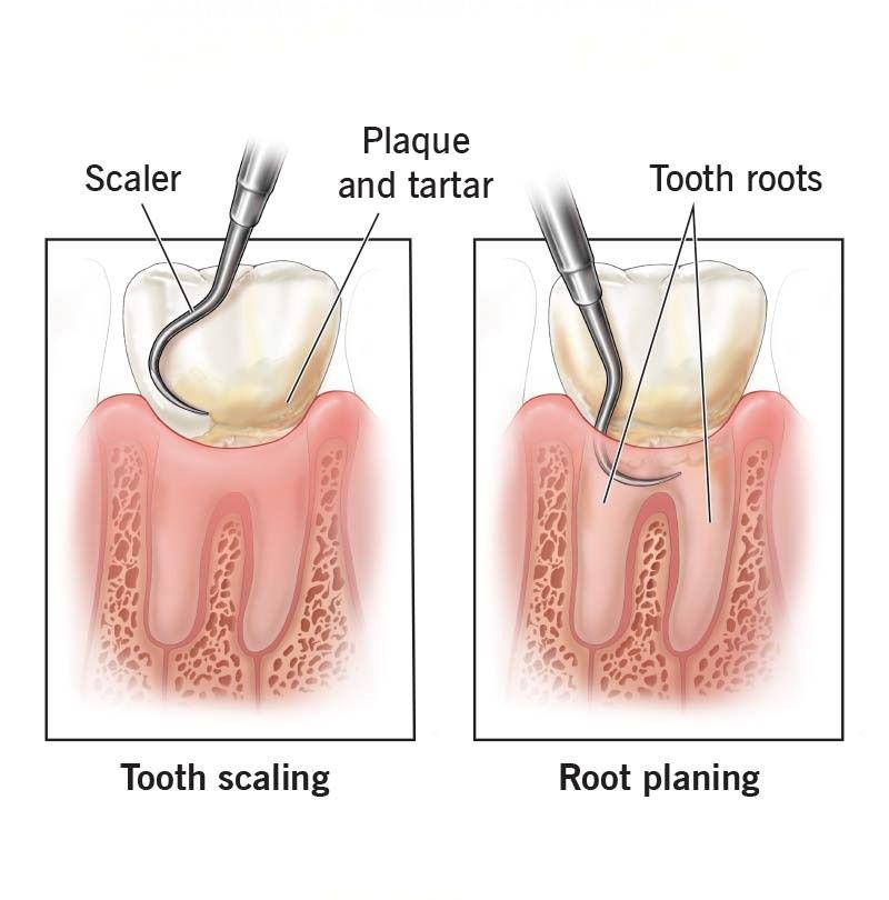 Scaling and Root Planing Hamilton, labeled clinical diagram showing tooth scaling to remove plaque and tartar above the gumline and root planing to smooth tooth roots below the gumline