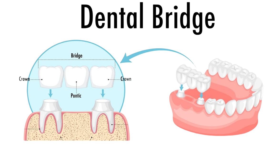 Same-day dental bridges Hamilton, anatomical diagram showing a three-unit dental bridge with two crowns and a pontic replacing a missing tooth between healthy adjacent teeth.