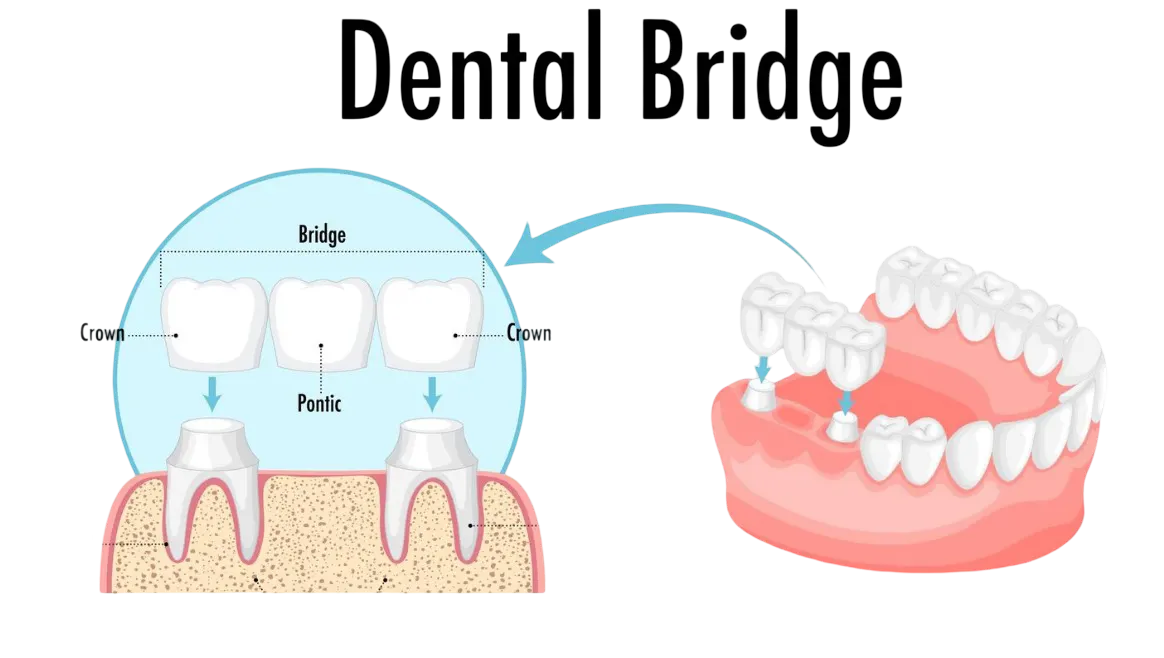 Same-day dental bridges Hamilton, anatomical diagram showing a three-unit dental bridge with two crowns and a pontic replacing a missing tooth between healthy adjacent teeth.