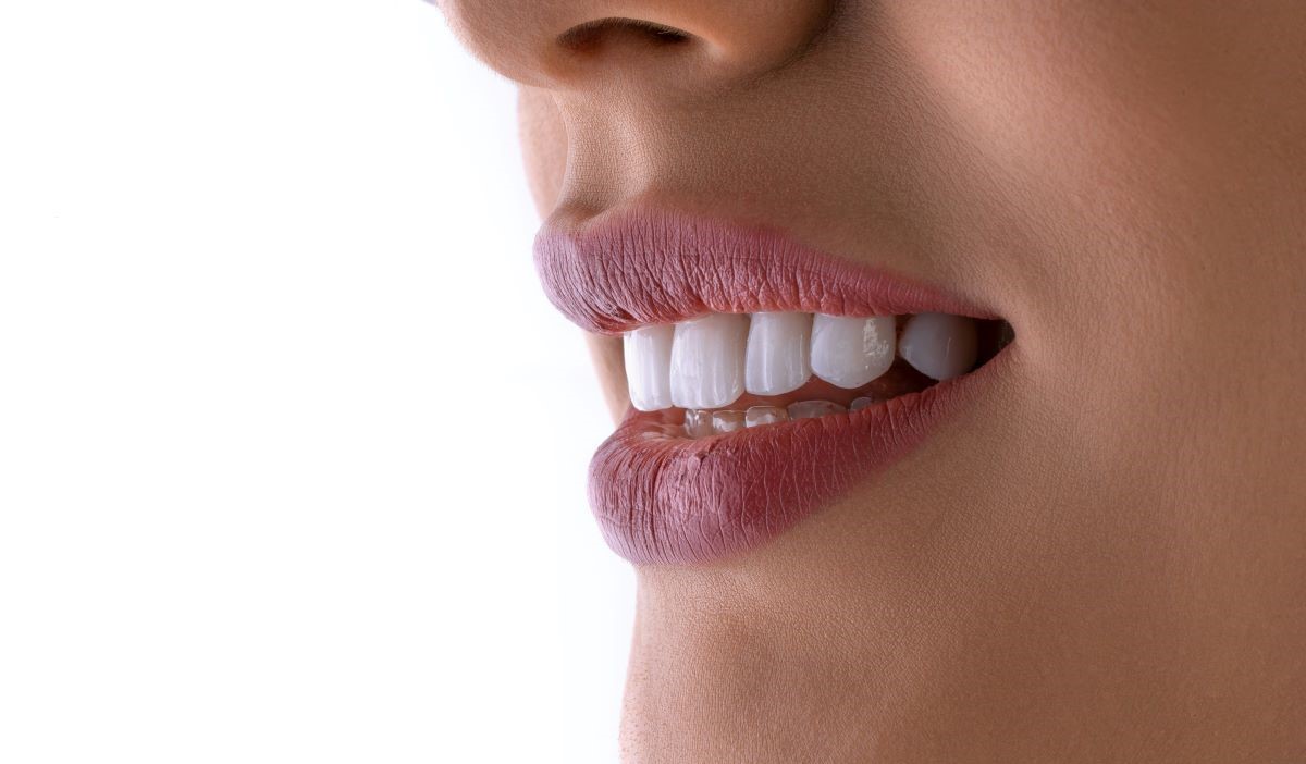 Smile Makeover
