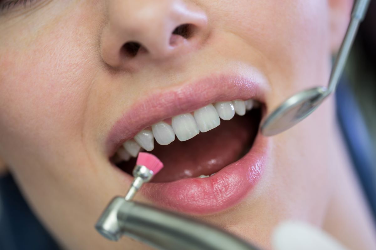 Teeth cleaning Hamilton, close-up of a patient receiving professional polishing with a pink prophy cup during a dental cleaning at Charlton Dentistry.