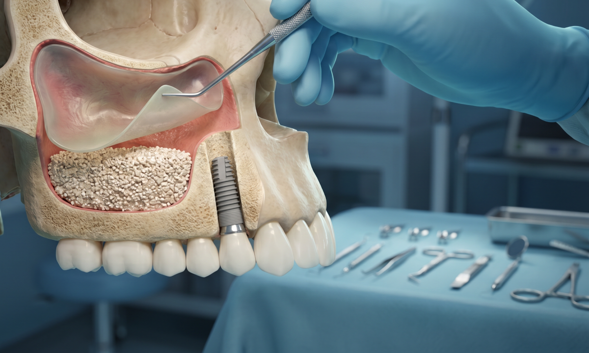 Sinus Lift