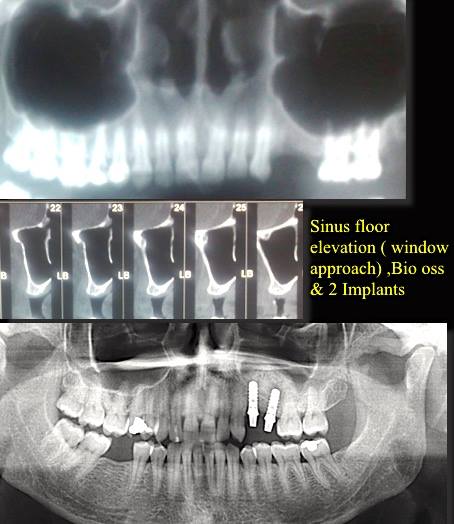 Root Canal Treatment Case